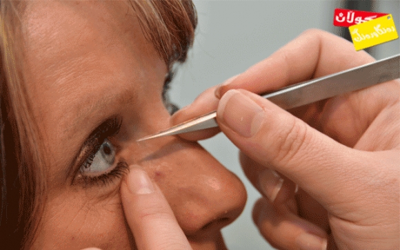 هۆكار و نیشانەكانی گیرانی كەناڵی فرمێسك